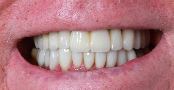 After dental implant treatment smile