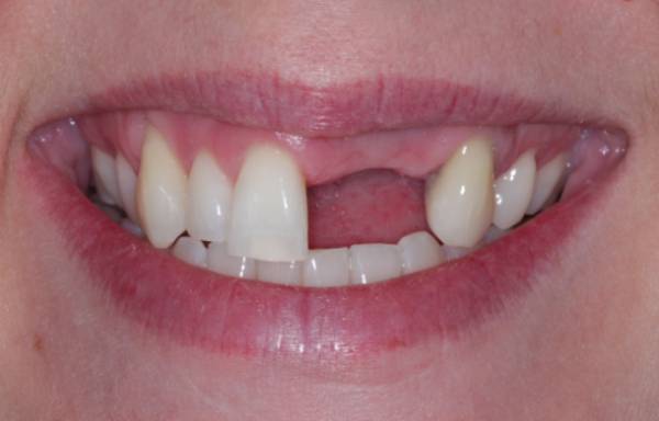Smile before dental implant treatment