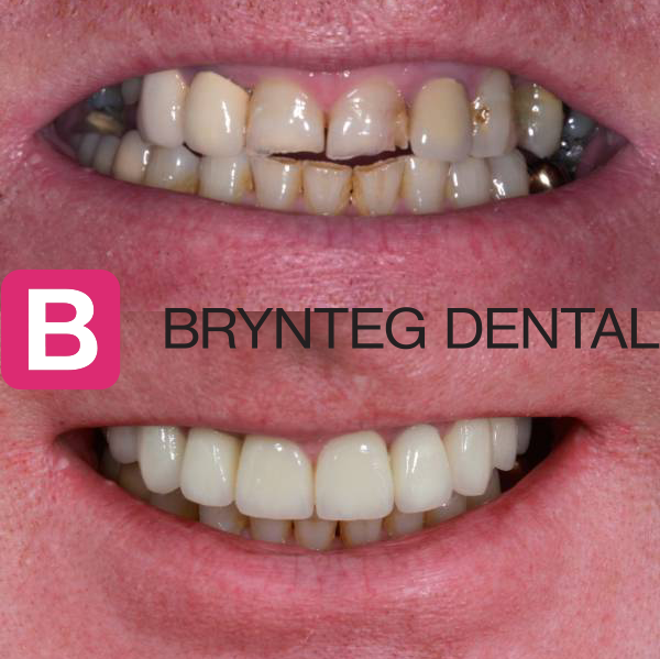 Before and after dental crown treatment