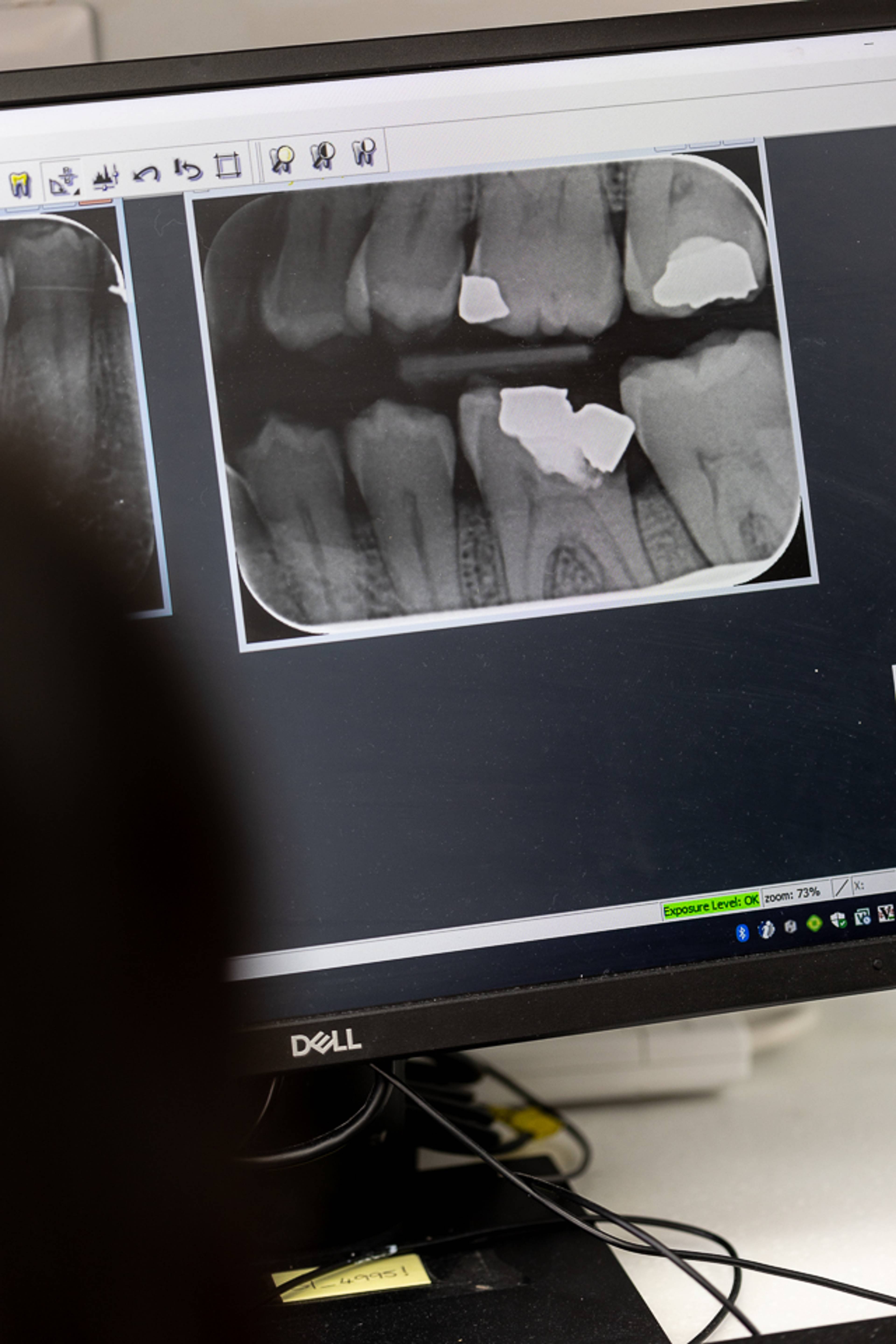 Xray of patient's teeth at Brynteg Dental