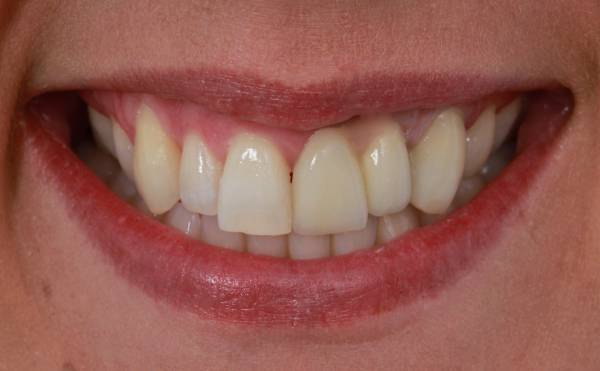 Smile after dental implant treatment