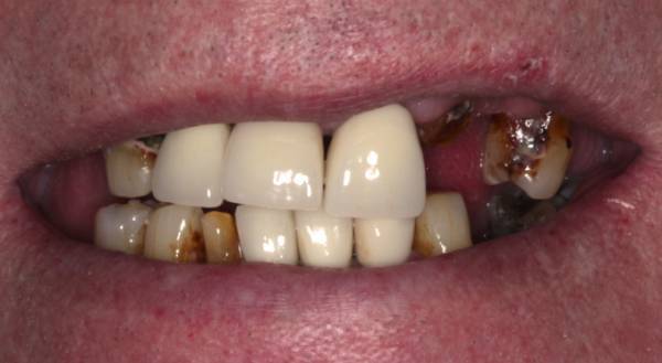 Smile before dental implant treatment