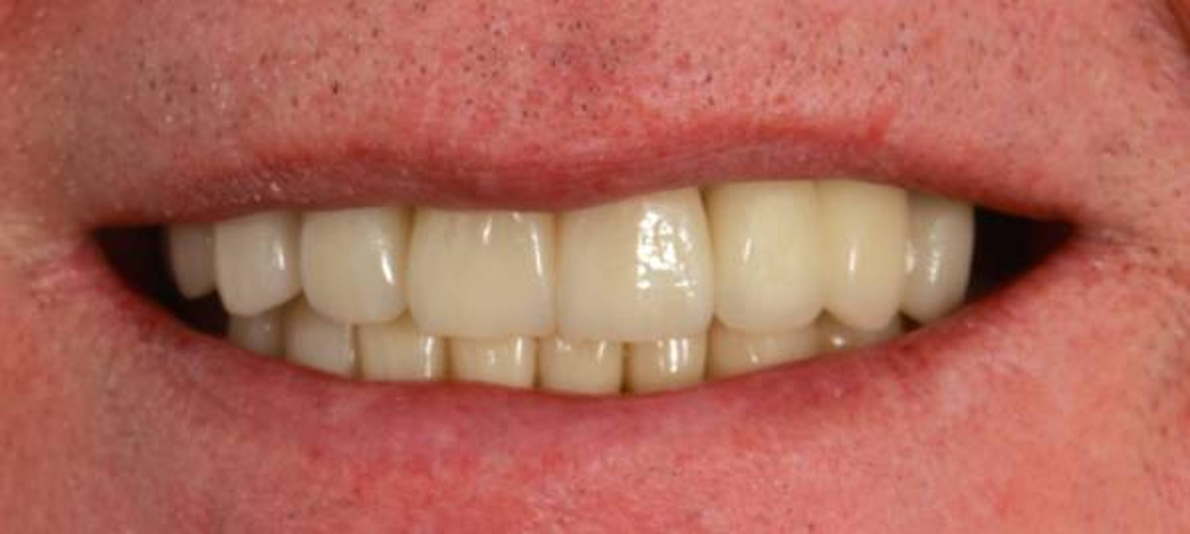 Smile after dental implant treatment