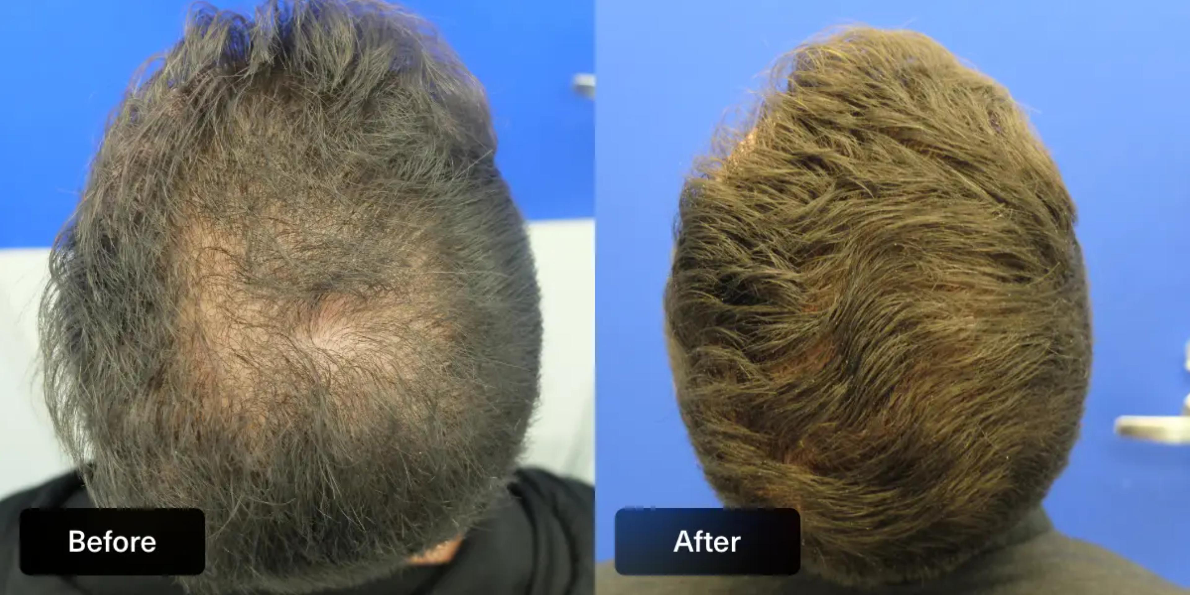 Finasteride Function Finasteride In Your 20S | Male Pattern Baldness (Androgenic Alopecia ...