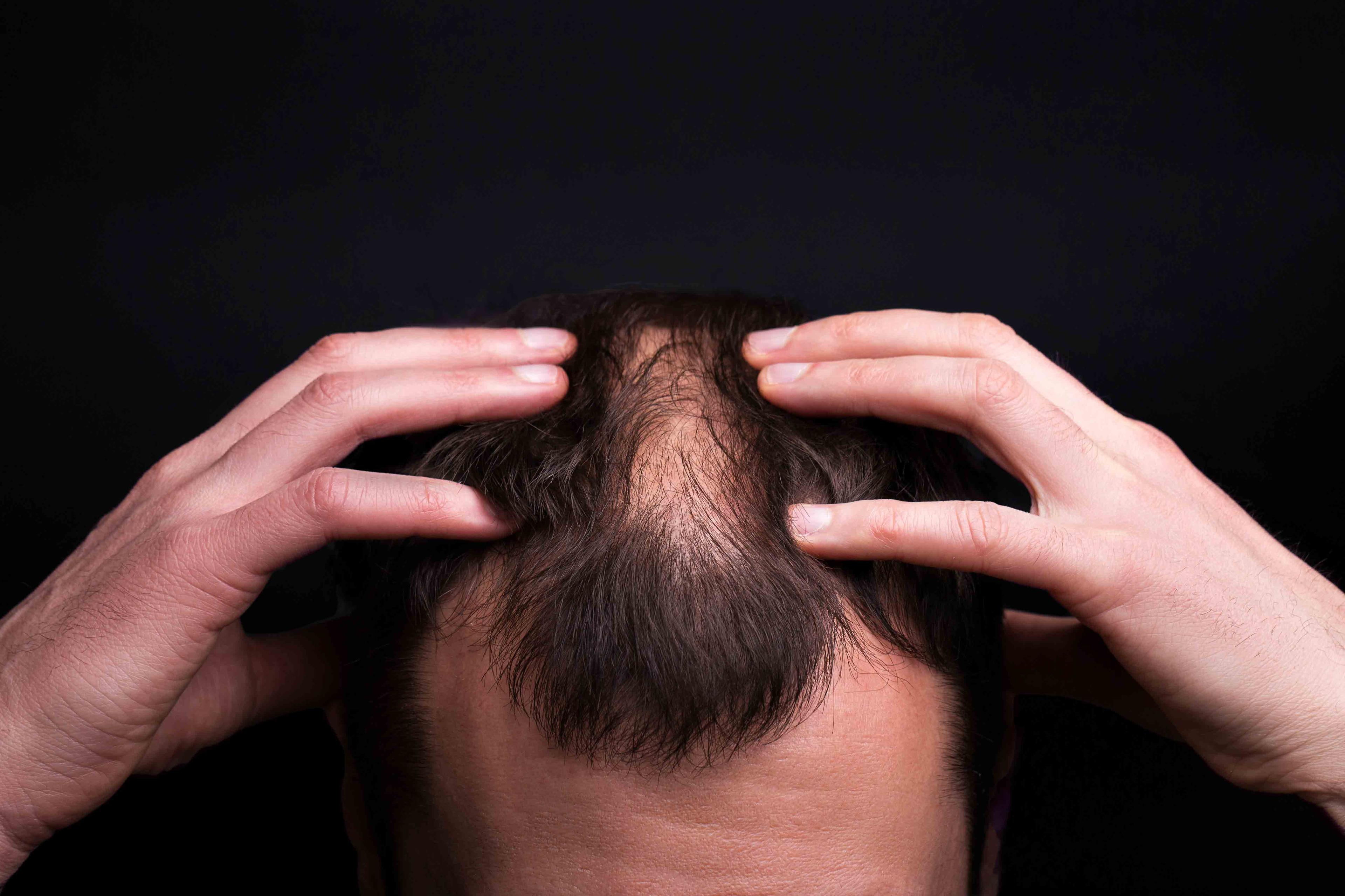 Young brunette man photographed from above touching his scalp with both hands. A small bald spot has developed in the centre of his head that is characteristic of androgenetic alopecia.