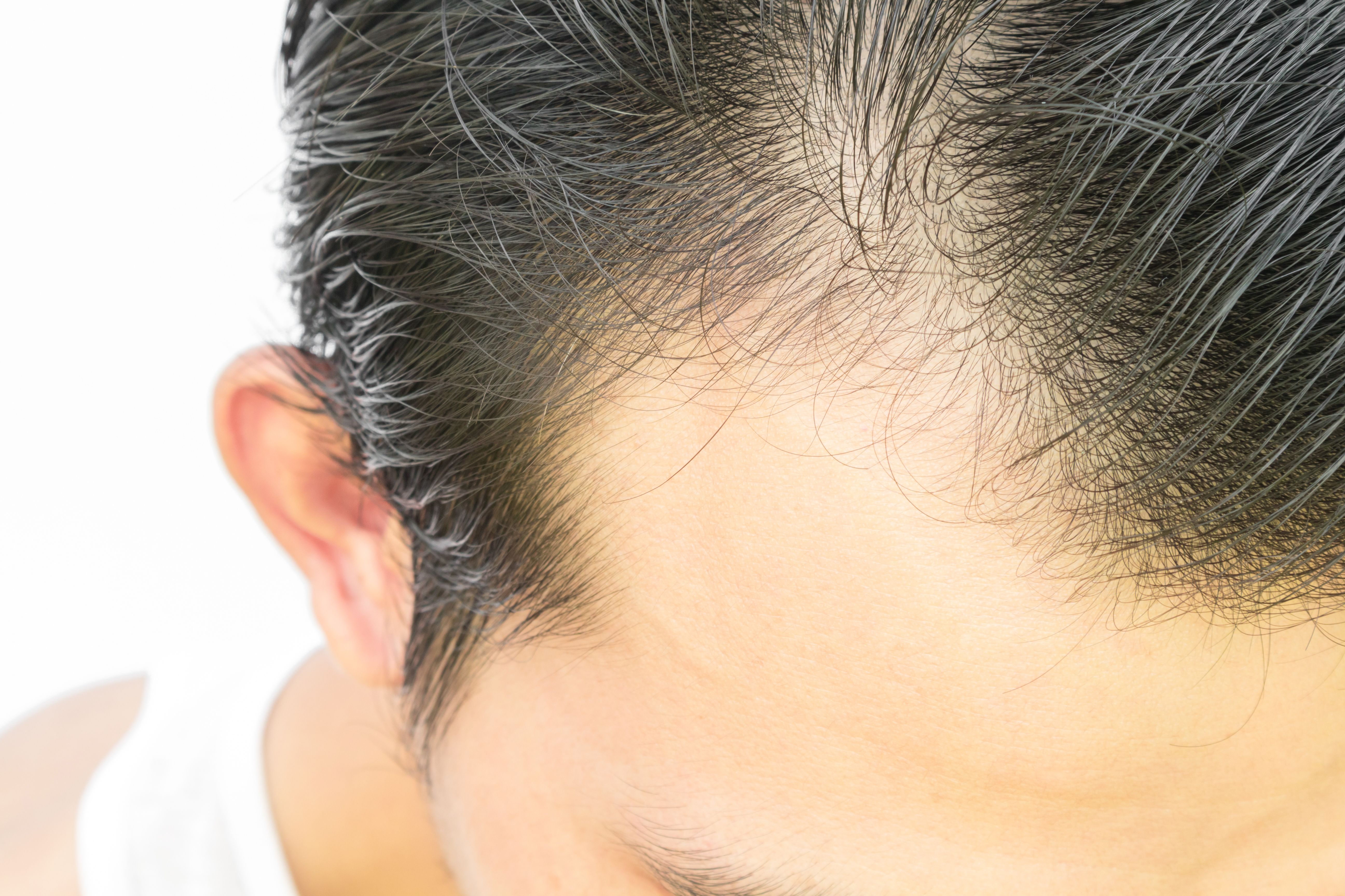 dutasteride for hair loss