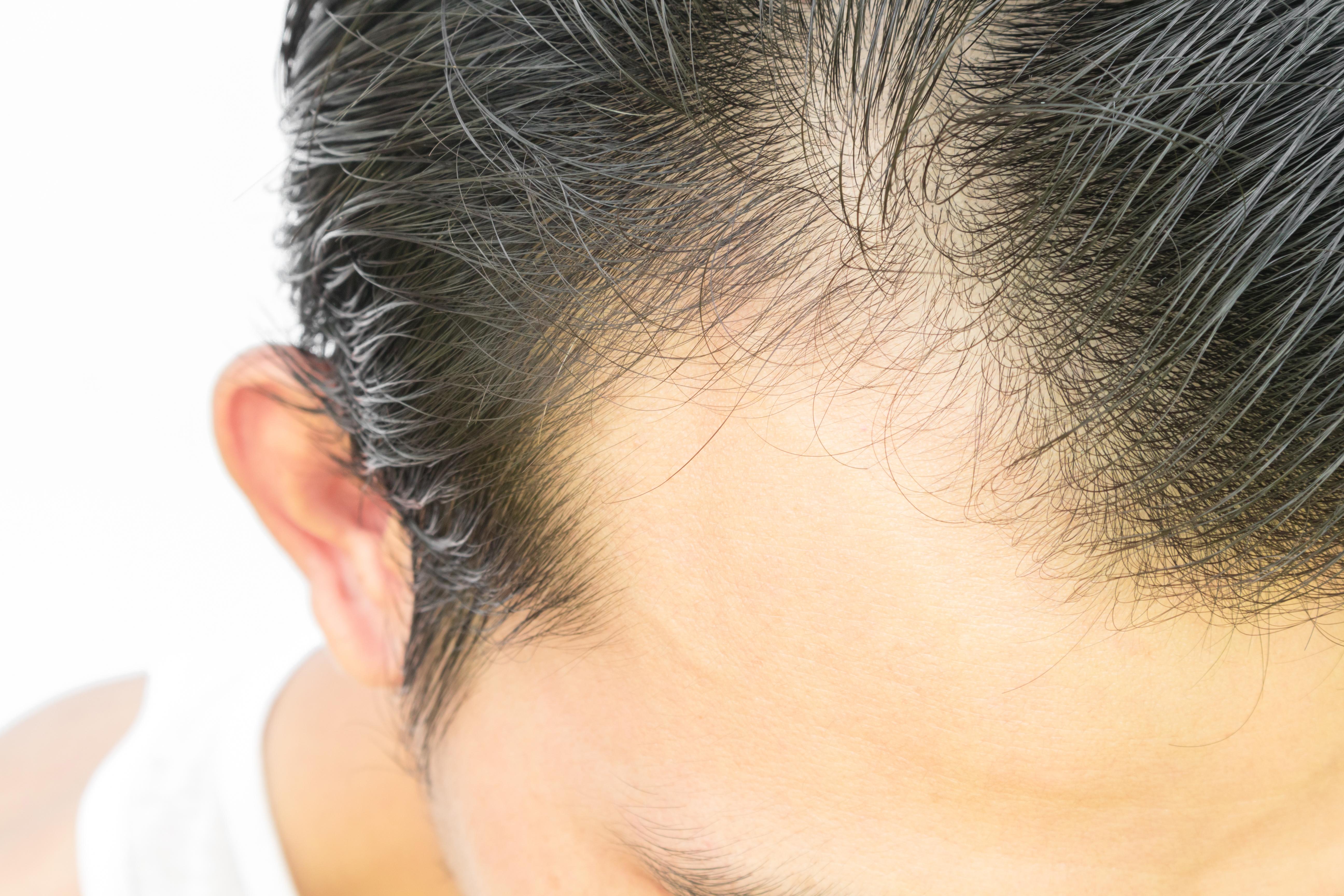 dutasteride-for-hair-loss-xyon