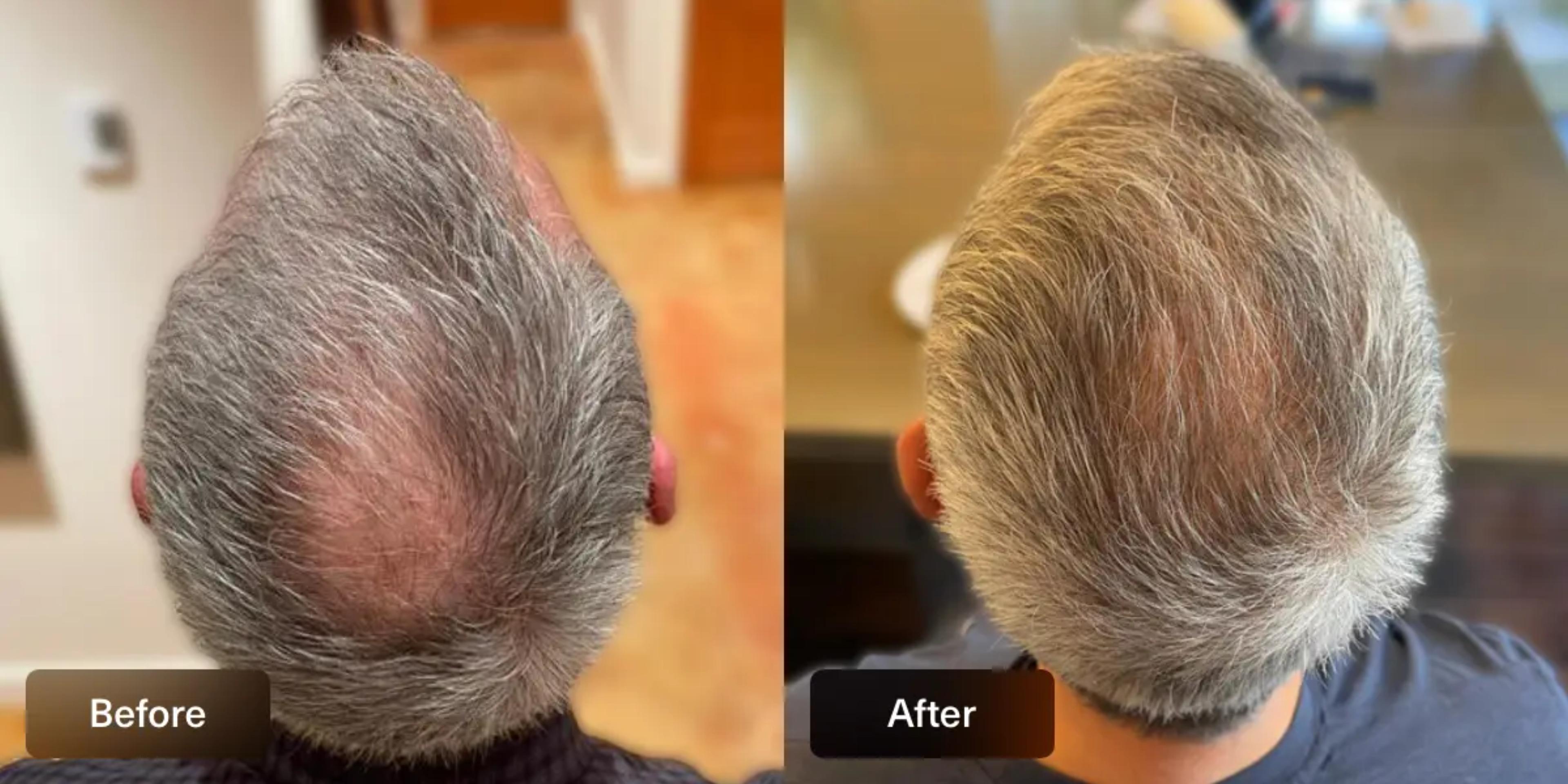 Before and After images of a XYON Topical Finasteride patient