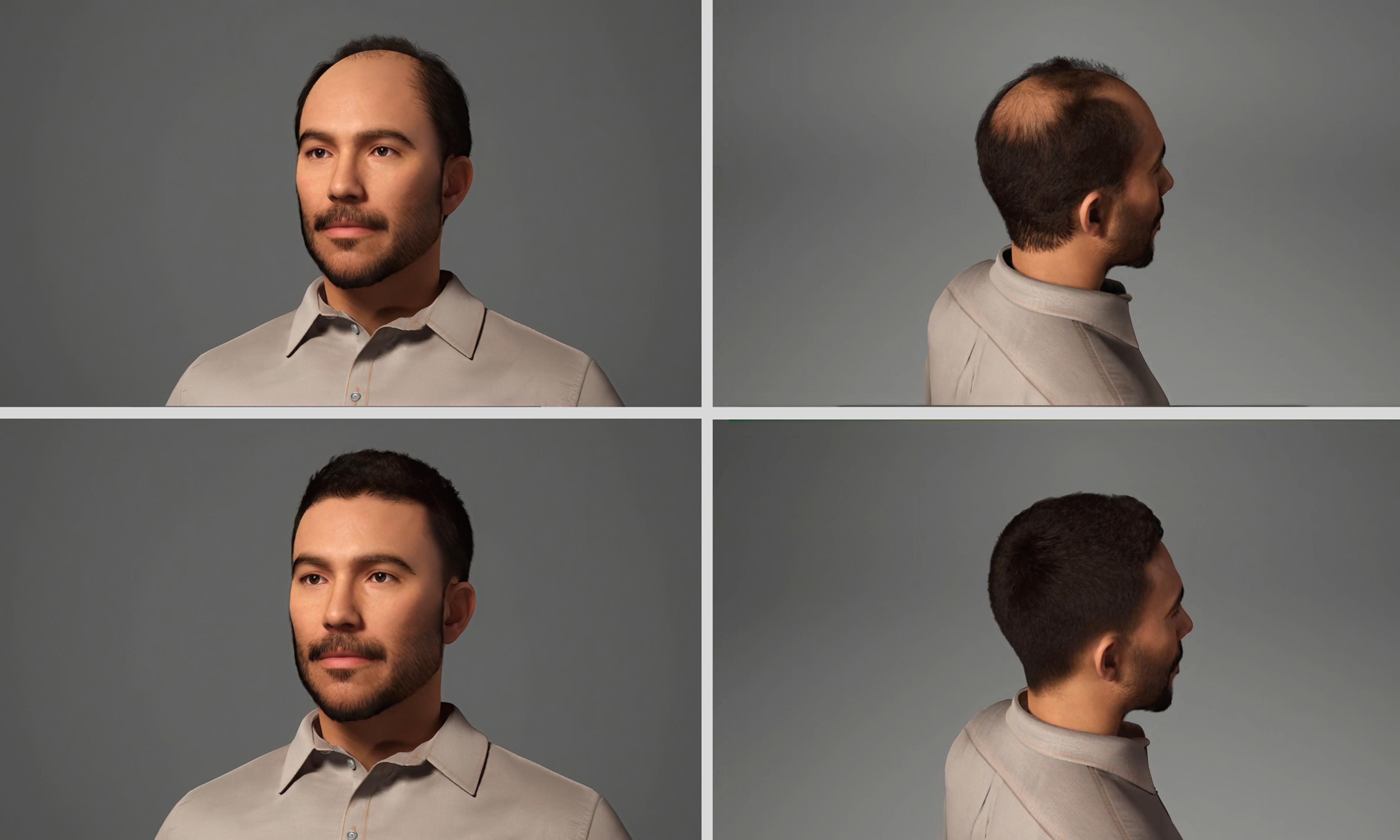 3D rendering of Asian man with hair loss at different stages of the Hamilton-Norwood scale.