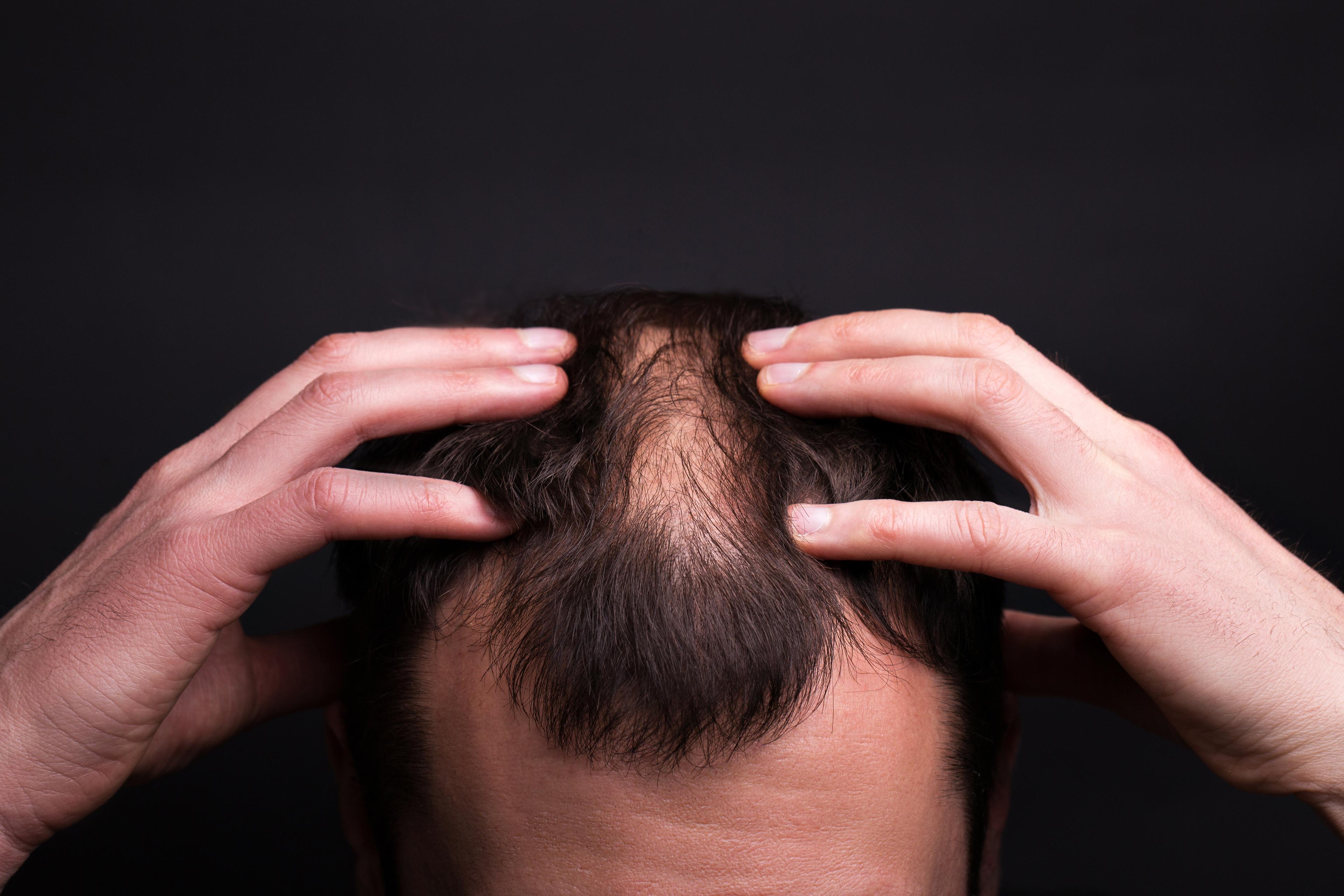 Brunette man with androgenetic alopecia touching his scalp.