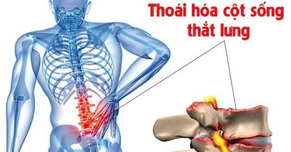 Yoga Trị Liệu Xương Khớp - Hành Trình Khôi Phục Sức Khỏe và Sự Linh Hoạt