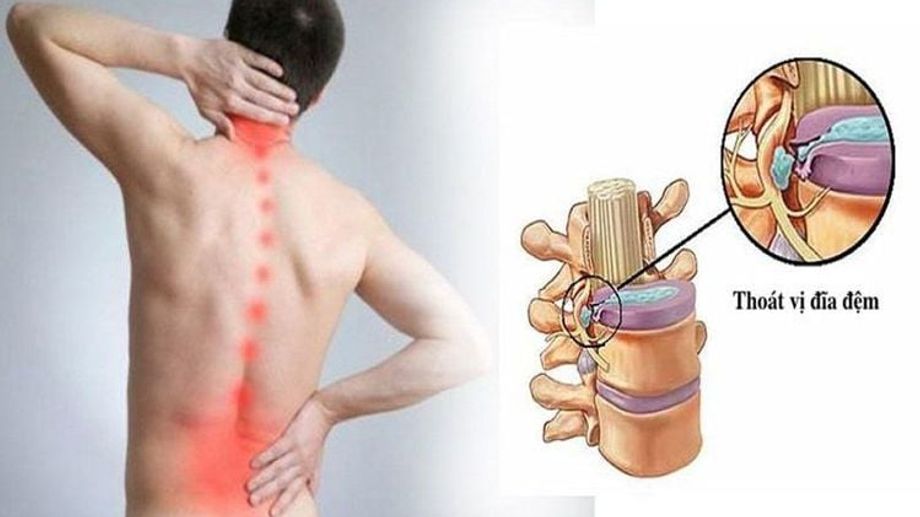 Bí Quyết Yoga Đánh Tan Đau Thắt Lưng Và Cổ