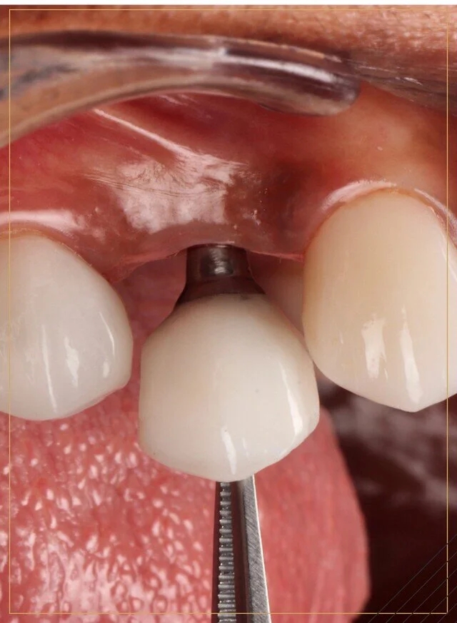What Are Dental Implants