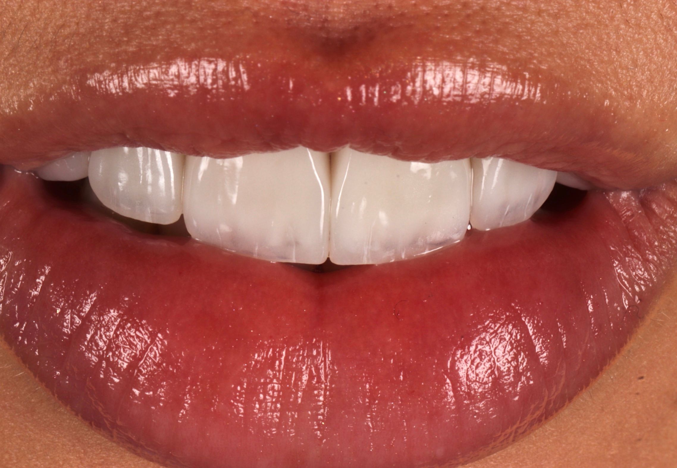 Beautiful white perfect teeth high-quality veneers in Houston