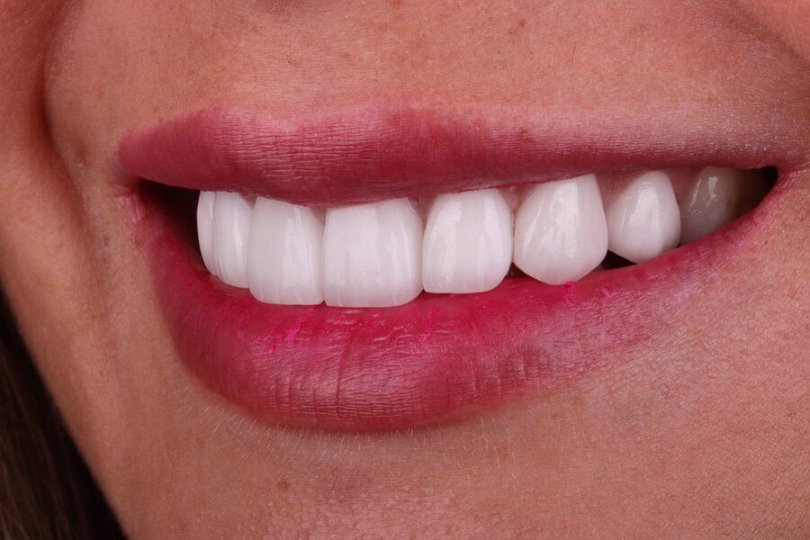 Closeup of a woman's beautiful smile with gorgeous, white, straight teeth. Natural-looking veneers from Sapphire Smiles in Houston.