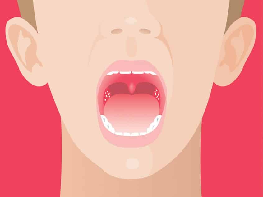 Strep Throat: Causes, Symptoms, Diagnosis, and Treatment