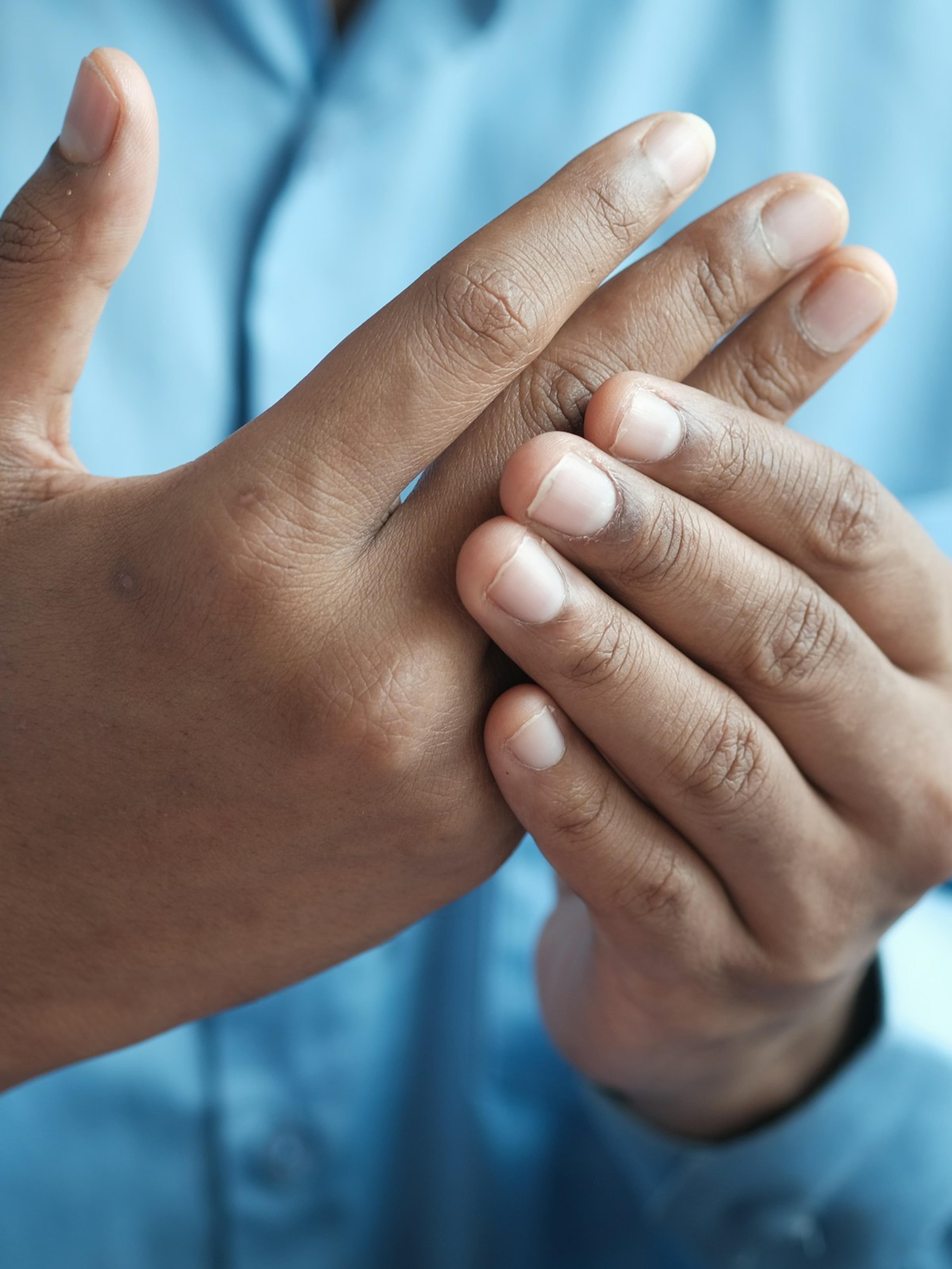 Man in a blue shirt rubbing his sore hand and fingers, the kind of symptom behind many carpal tunnel workers’ comp claims