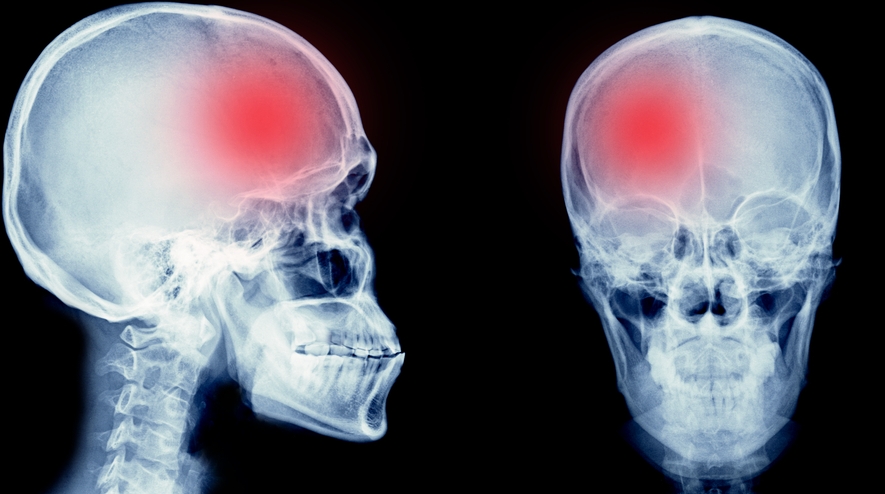 Image Somerset Traumatic Brain Injury Lawyers