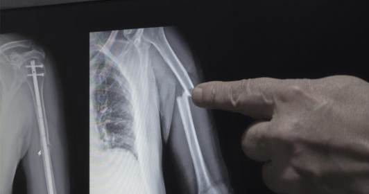 Image Types of Car Accidents in New Jersey