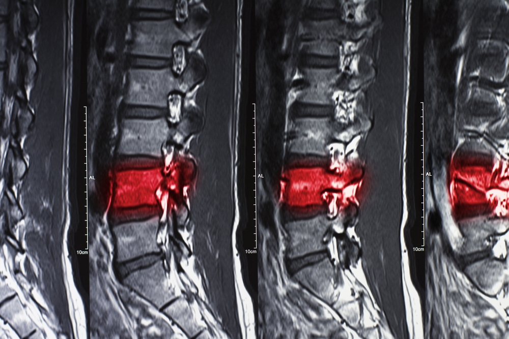 Image New Jersey Spinal Cord Injury Lawyers