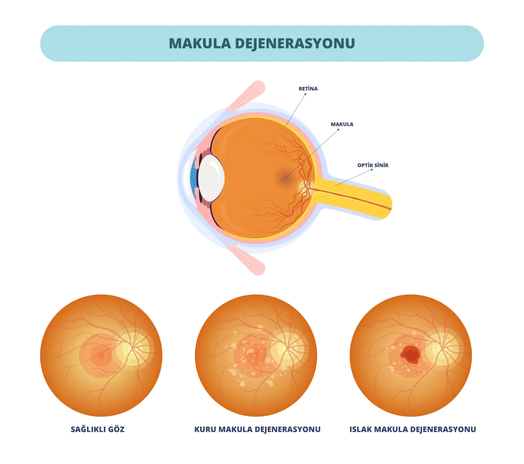 Yaşa Bağlı Makula Dejenerasyonu (Sarı Nokta Hastalığı) Nedir?