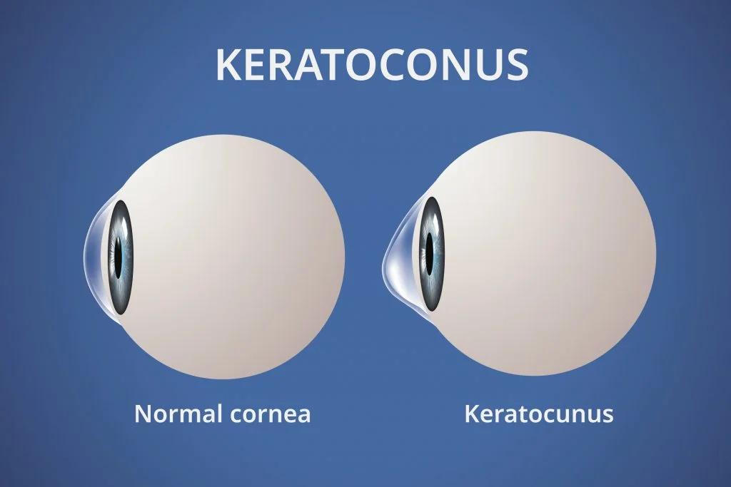 Keratokonus ve Keratokonusun Tedavisi