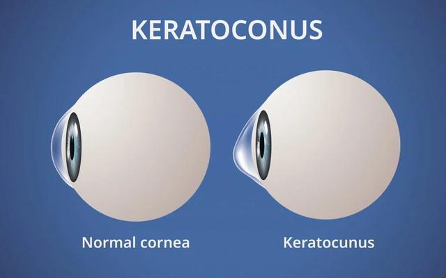 Keratokonus ve Keratokonusun Tedavisi