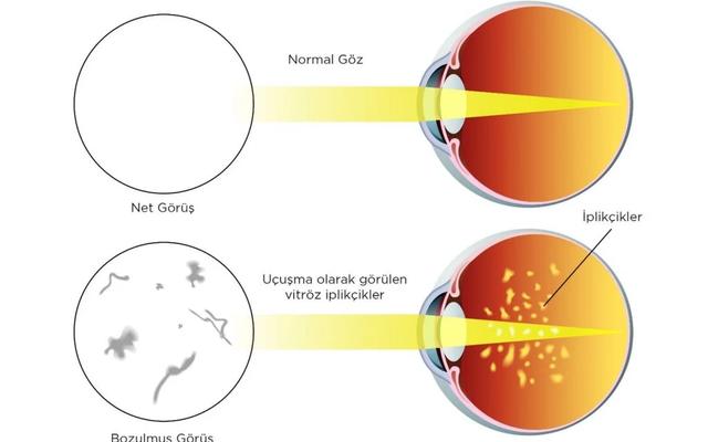 Gözde Uçuşan Cisimcikler | Nedenleri ve Daha Fazlası