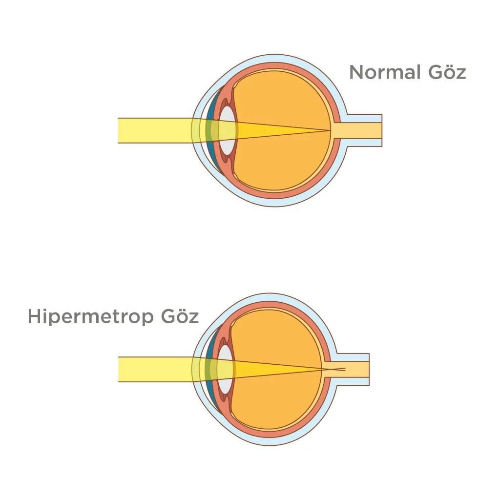 Hipermetropi
