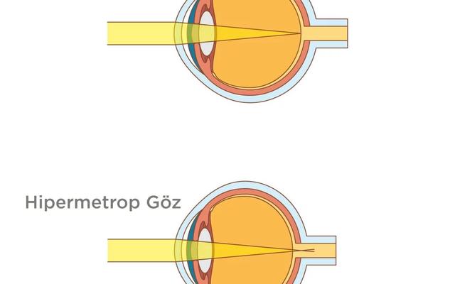 Hipermetropi