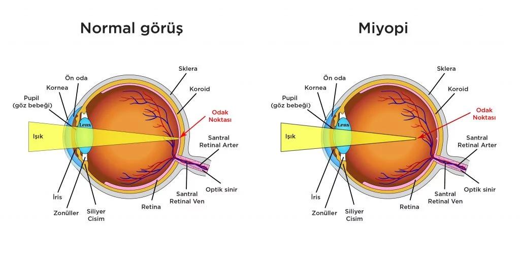 Miyopi
