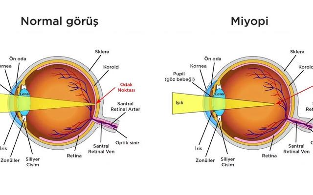 Miyopi