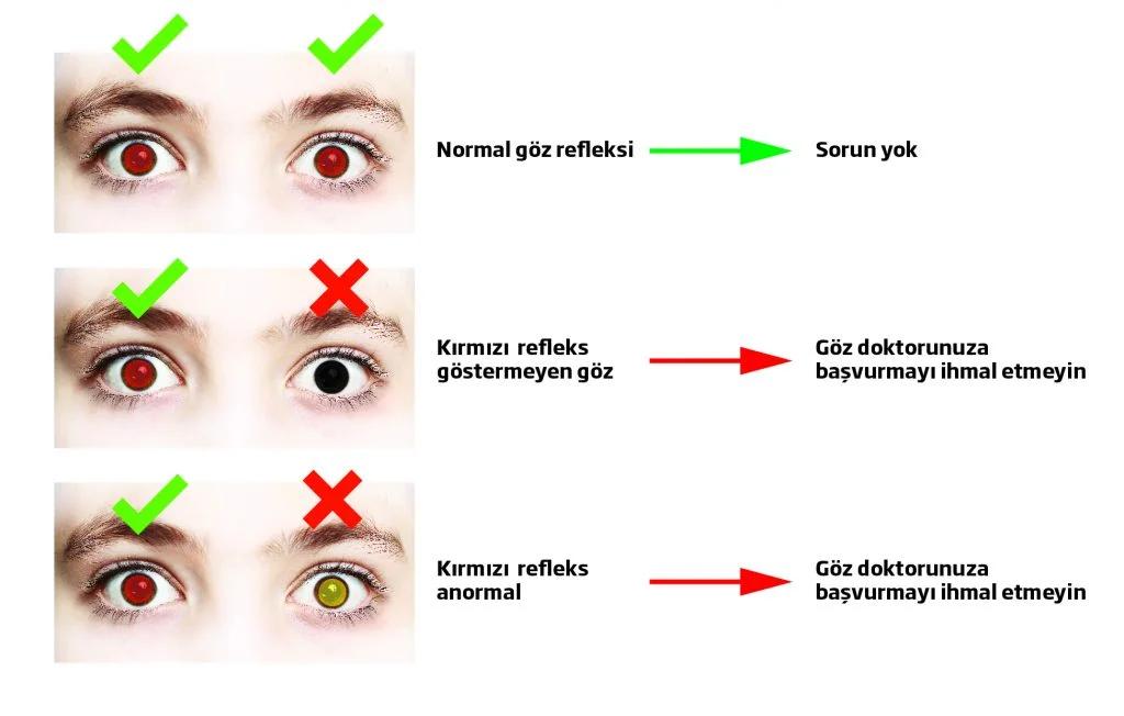 Çocuklarda Göz Sağlığı