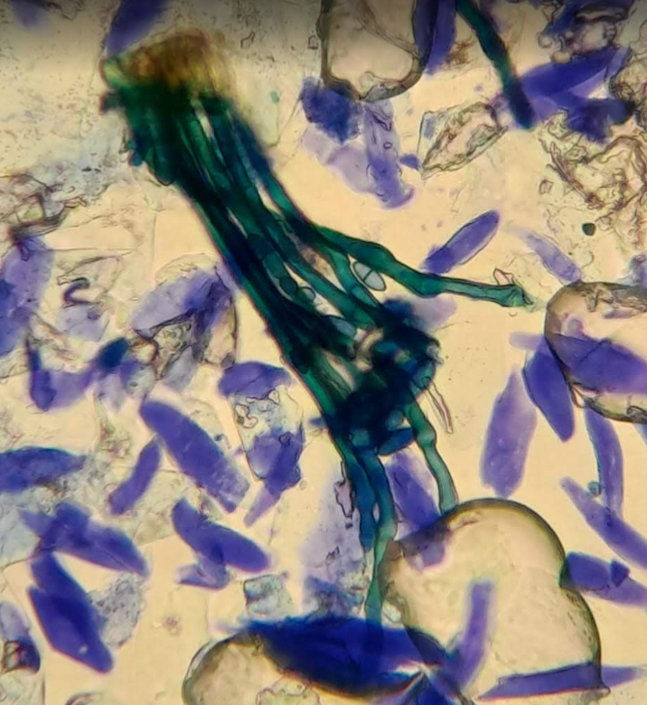 Figure 9, fungal hyphae (green)visible in superficial lesion smear viewed under the microscope