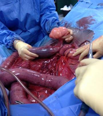 Figure 2 — A strangulating lipoma surgically removed from the Ileus (in the hand of the surgeon – top right). Notice the intestinal damage caused by the obstruction, and lack of blood supply to the GI tract adjacent to the lipoma (looking dark purple and congested red).