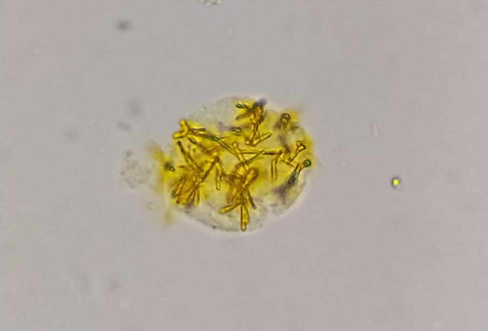 Figure 12. Bilirubin crystals. (Courtesy of Dr Mustafa Elsobky)