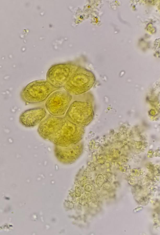 Figure 3. Epithelial cells. Bilirubin stain. (courtesy of Dr Mustafa Elsobky)