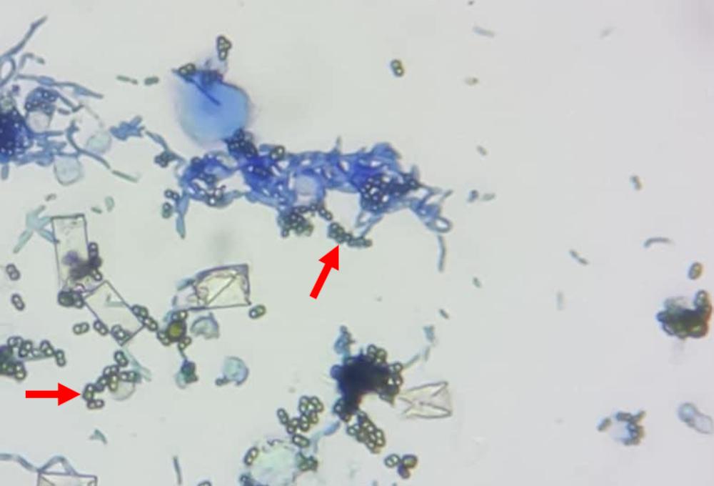 Figure 1. Numerous erythrocytes (arrows) in urine sediment. Also note the presence of bacterial rods, struvite crystals and fungal hyphae. (Courtesy of Dr An-Ka Sarapata).