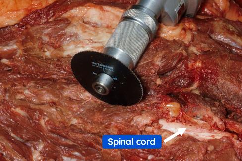 Figure 4 — Continuing to expose the spinal cord on the right side