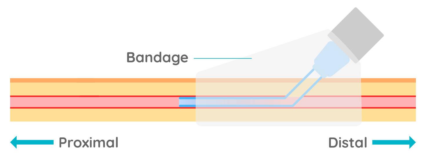 Figure 8 - The catheter should be taped in place and lightly bandaged where being left in place for in-patients. The catheter should be checked regularly for signs of swelling or inflammation and flushed every 4 hours.