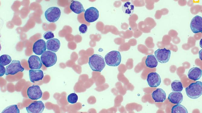 Figure 9 — Numerous large lymphocytes. Note they are larger than the neutrophil in the top of the image. Reproduced by kind permission of Dr Kate Schlicher Baker.