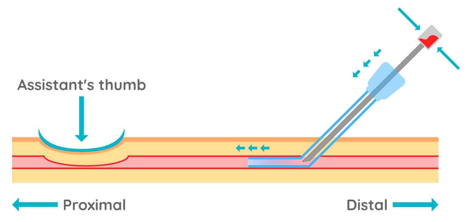 Figure 6 - Dexterity and a steady hand are needed to stabilise the stylet hub whilst pushing the catheter sheath forward, into the vein.