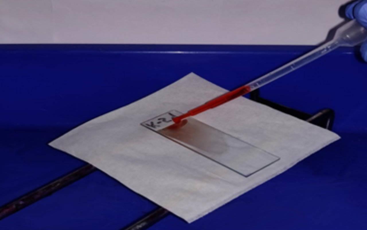 Figure 4 — Application of Fields stain B (red stain)