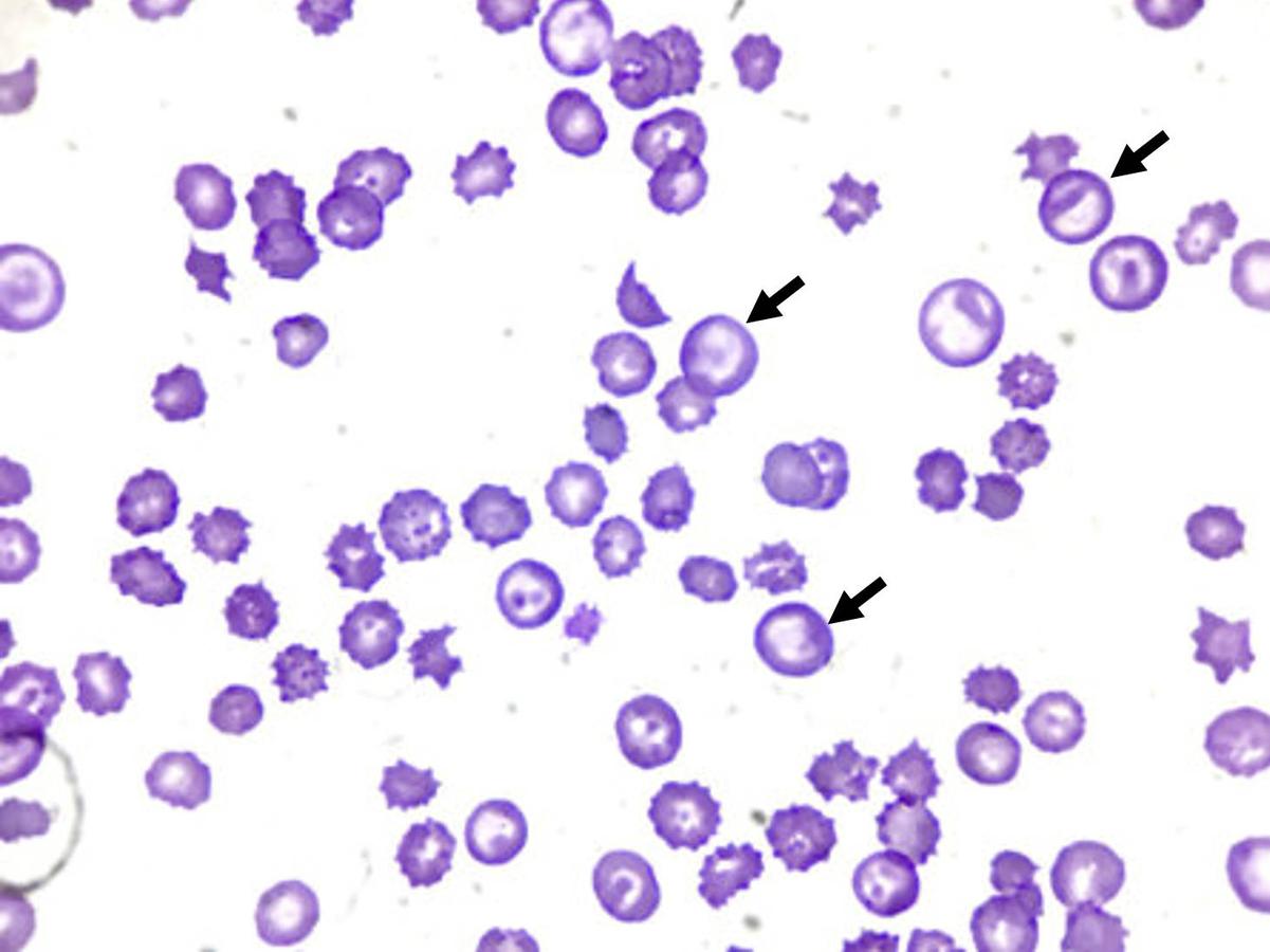 Figure 13 — Variation in cell size (anisocytosis). The cells marked with an arrow are macrocytic (larger than normal).