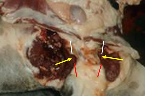 Figure 11 — Cutting through the pelvis
