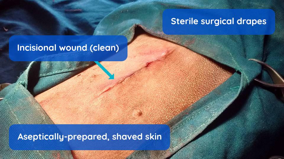 Figure 1 - An incisional (clean) wound created by the surgeon in a patient that is healthy is classified as "clean".