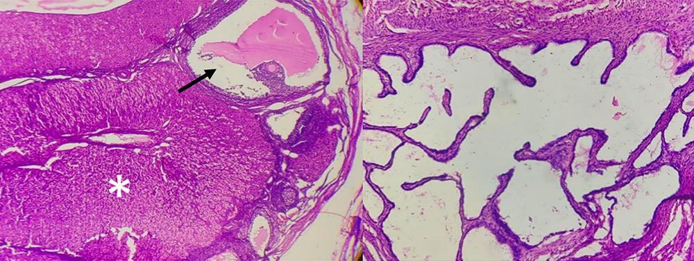 Figure 4 — Histopathological examination of remnant ovarian tissue. Left, an ovarian follicle (arrow) and corpus luteum (asterisk). Right, cystic follicles are lined by one to four layers of cuboidal cells. HE.