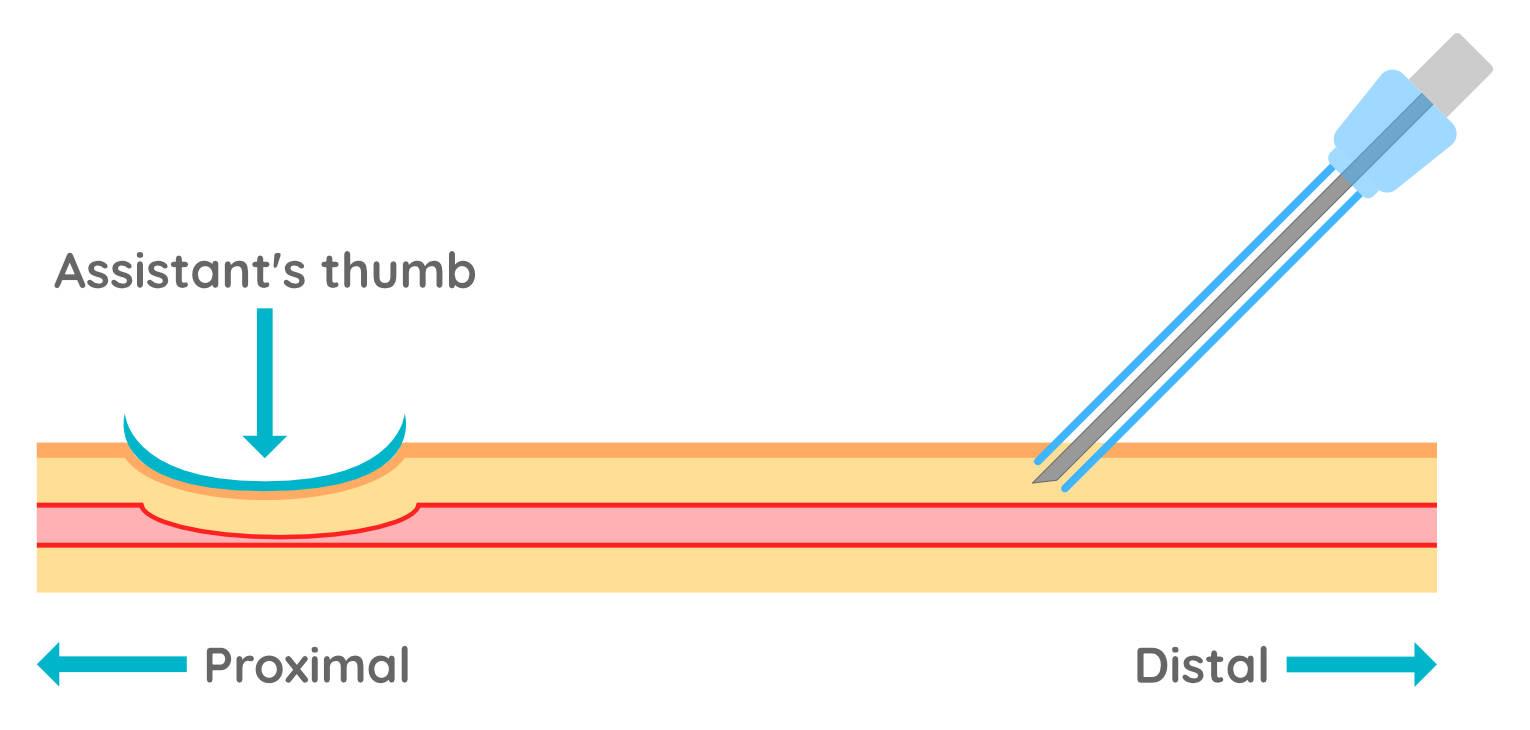Figure 4 - The skin is highly innervated and so passing the needle through the skin is the most painful part of the procedure. Try to first pass through the skin and then adjust pressure and angle to advance through the vessel wall.