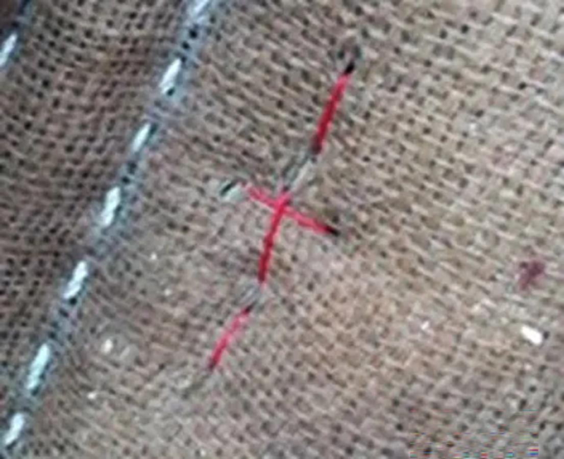 Figure 16 The red stiching pulls the padding away from a wound and can be released after healing has occurred