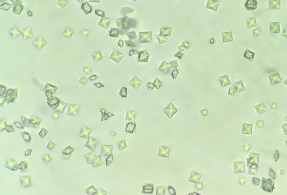 Figure 10. Numerous calcium oxalate crystals. (Courtesy of Dr Sree Varsha)